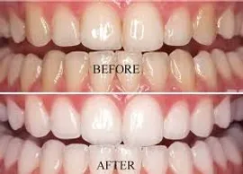 Teeth Whitening Before and After
